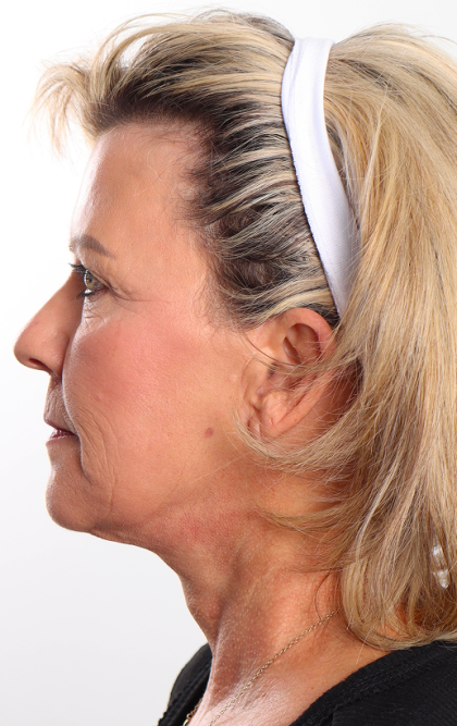 Facelift Before & After Patient #4110