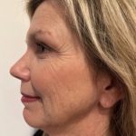 Morpheus8 Before & After Patient #4156