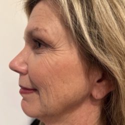 Morpheus8 Before & After Patient #4156