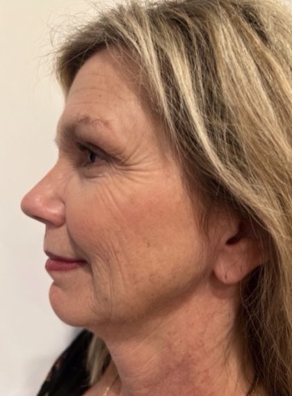 Morpheus8 Before & After Patient #4156