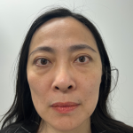 Blepharoplasty Before & After Patient #4195