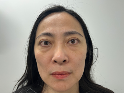 Blepharoplasty Before & After Patient #4195