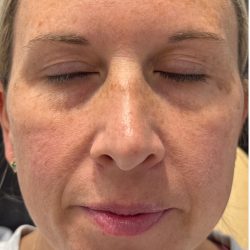MOXI Laser Before & After Patient #4203