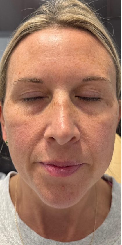 MOXI Laser Before & After Patient #4203