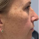 MOXI Laser Before & After Patient #4203