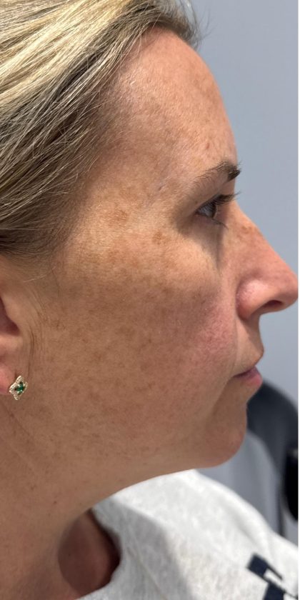 MOXI Laser Before & After Patient #4203
