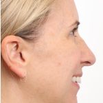 MOXI Laser Before & After Patient #4203