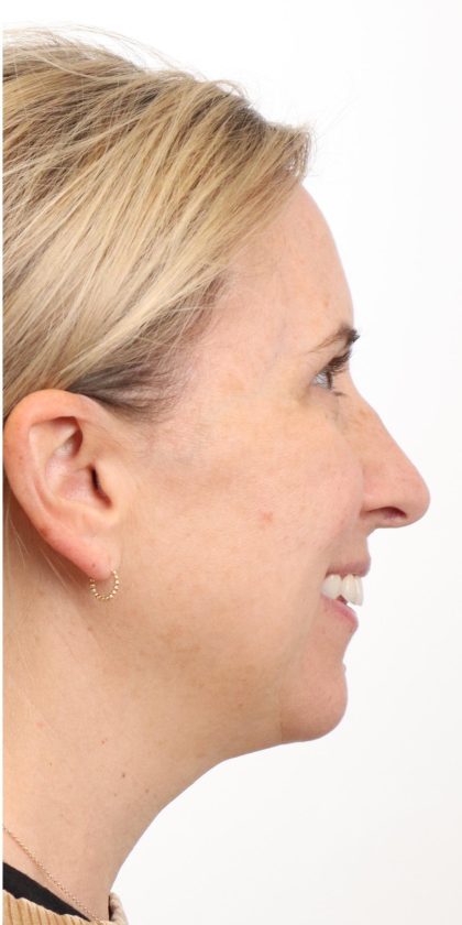 MOXI Laser Before & After Patient #4203