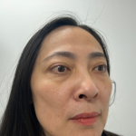 Blepharoplasty Before & After Patient #4195