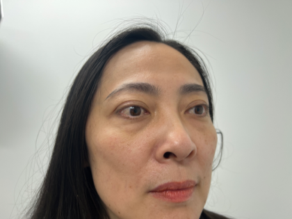Blepharoplasty Before & After Patient #4195