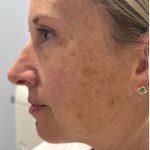 MOXI Laser Before & After Patient #4203