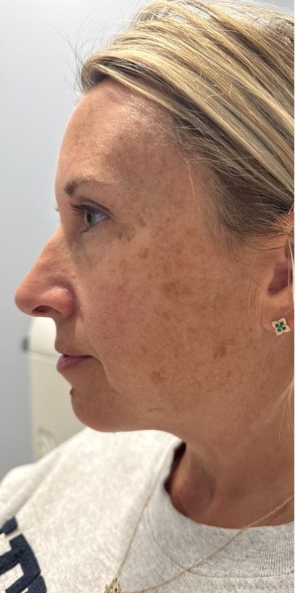MOXI Laser Before & After Patient #4203