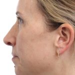 MOXI Laser Before & After Patient #4203