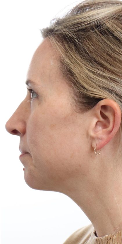 MOXI Laser Before & After Patient #4203