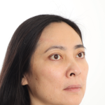 Blepharoplasty Before & After Patient #4195