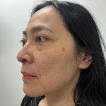 Blepharoplasty Before & After Patient #4195