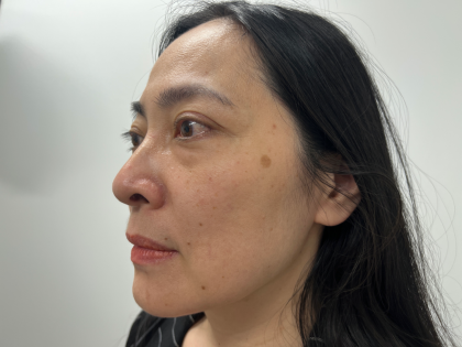Blepharoplasty Before & After Patient #4195