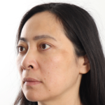 Blepharoplasty Before & After Patient #4195