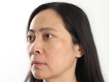 Blepharoplasty Before & After Patient #4195