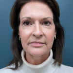 Facelift Before & After Patient #4293
