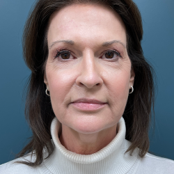 Facelift Before & After Patient #4293