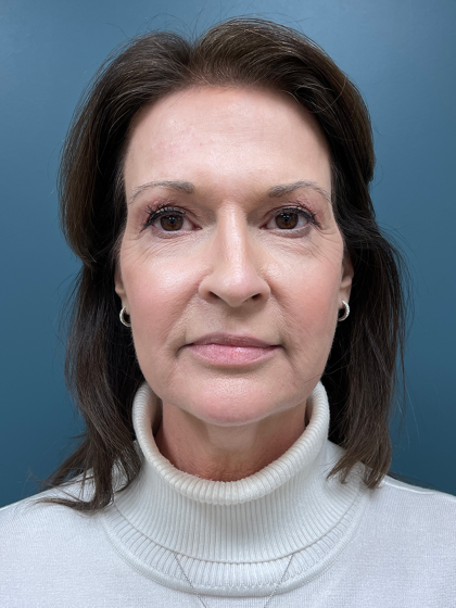 Facelift Before & After Patient #4293