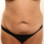 Tummy Tuck Before & After Patient #4304