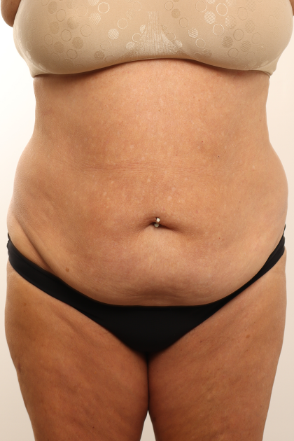 Tummy Tuck Before & After Patient #4304
