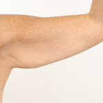 Arm Lift Before & After Patient #4305