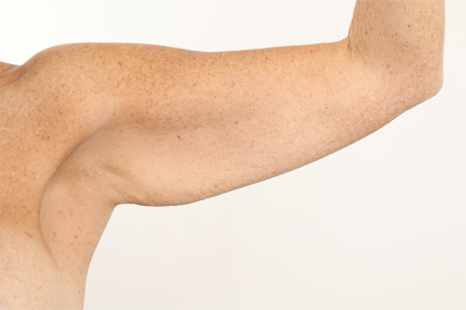 Arm Lift Before & After Patient #4305