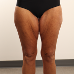 Thigh Lift Before & After Patient #4348