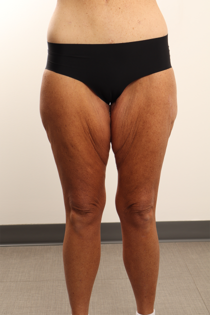 Thigh Lift Before & After Patient #4348