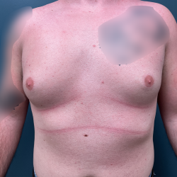 Gynecomastia Before & After Patient #4213