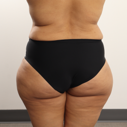 Brazilian Butt Lift Before & After Patient #4226