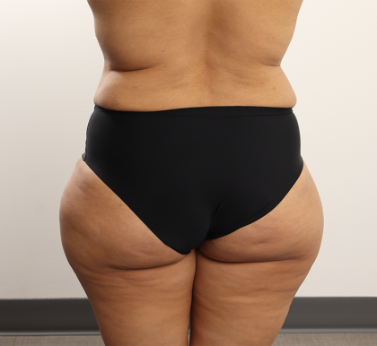 Brazilian Butt Lift Before & After Patient #4226