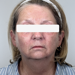 Morpheus8 Before & After Patient #4227