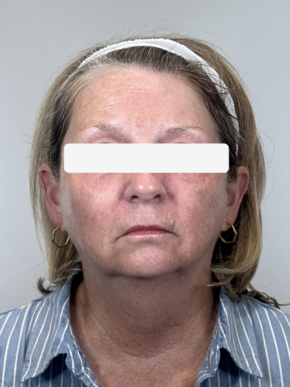 Morpheus8 Before & After Patient #4227