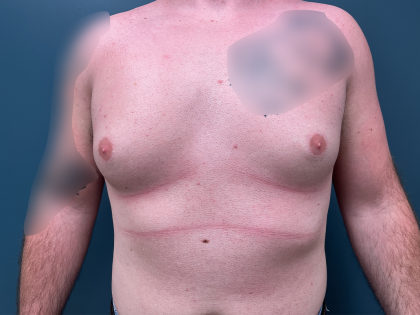 Gynecomastia Before & After Patient #4213