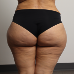 Brazilian Butt Lift Before & After Patient #4226
