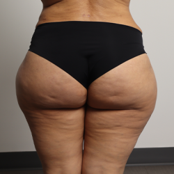 Brazilian Butt Lift Before & After Patient #4226