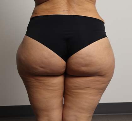 Brazilian Butt Lift Before & After Patient #4226
