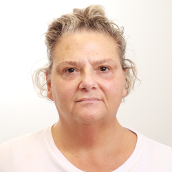 MOXI Laser Before & After Patient #4254