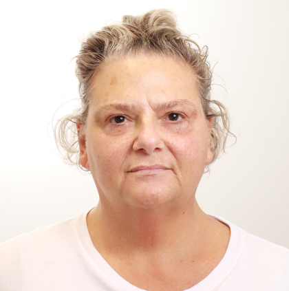 MOXI Laser Before & After Patient #4254
