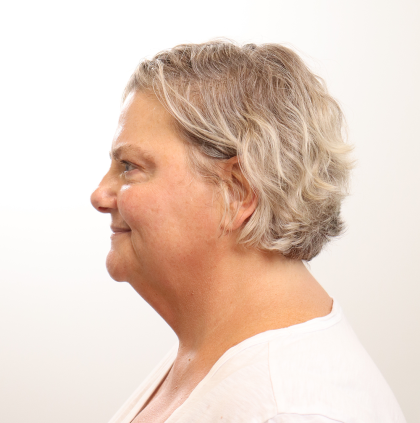 MOXI Laser Before & After Patient #4254