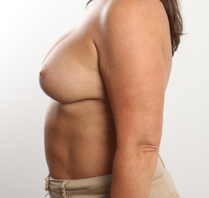 Breast Revision Before & After Patient #4257
