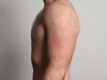Gynecomastia Before & After Patient #4213