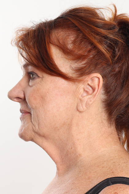Rhinoplasty Before & After Patient #4302