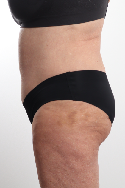Tummy Tuck Before & After Patient #4304