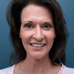Facelift Before & After Patient #4293