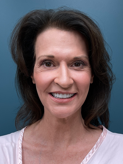 Facelift Before & After Patient #4293
